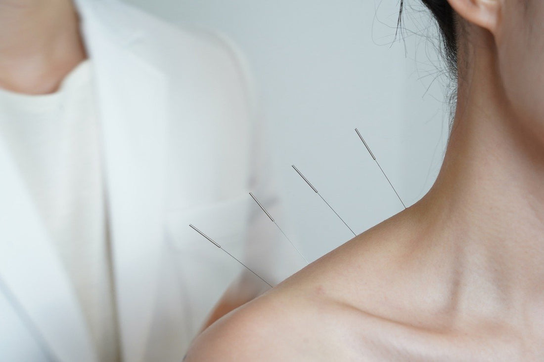 Acupuncture The Perfect Solution for Neck Pain