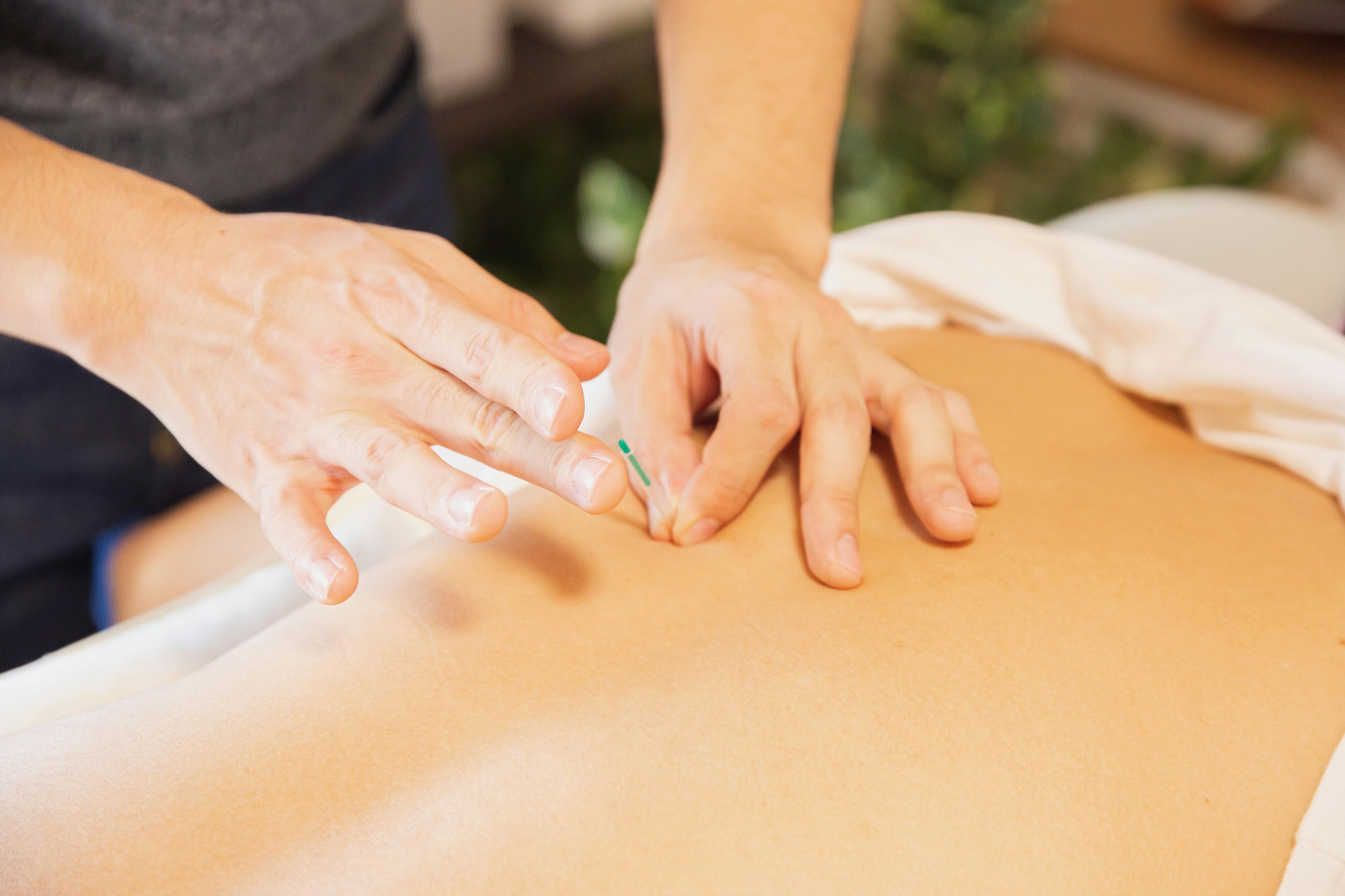 Is Acupuncture Covered by Insurance in Ontario?
