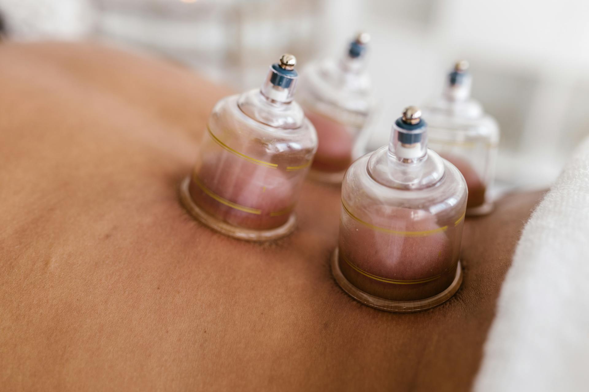Cupping therapy cups applied to a person’s back during a therapeutic treatment session.