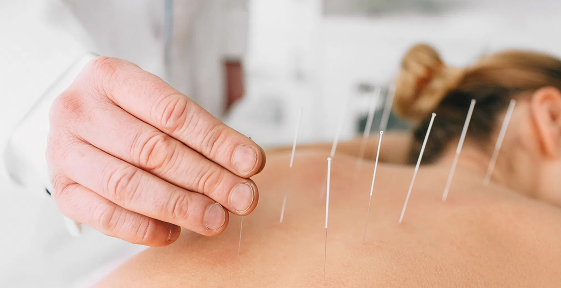 Dry Needling vs Acupuncture: The Difference